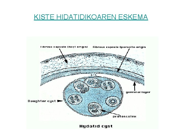 KISTE HIDATIDIKOAREN ESKEMA 