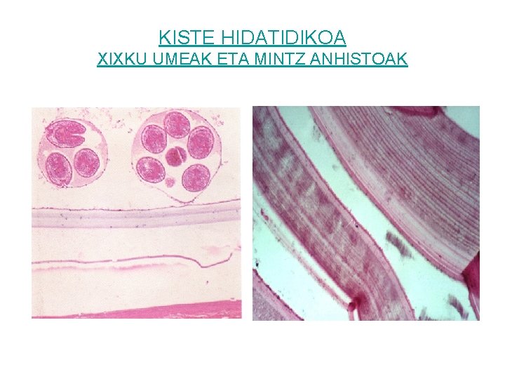 KISTE HIDATIDIKOA XIXKU UMEAK ETA MINTZ ANHISTOAK 