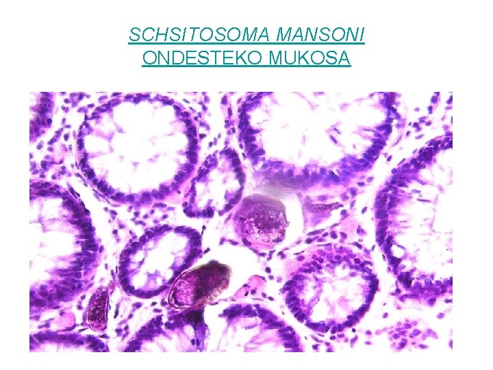 SCHSITOSOMA MANSONI ONDESTEKO MUKOSA 