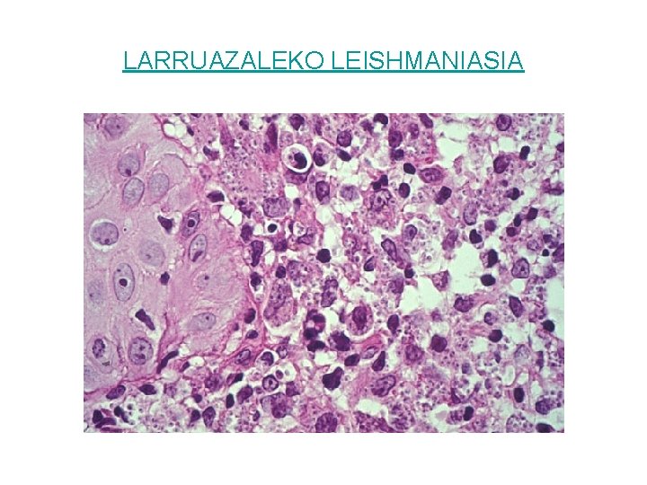 LARRUAZALEKO LEISHMANIASIA 