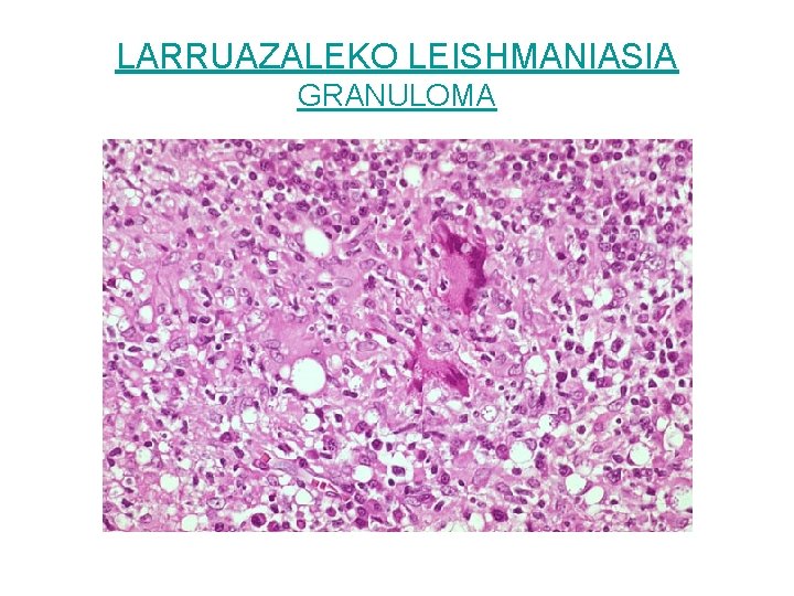 LARRUAZALEKO LEISHMANIASIA GRANULOMA 