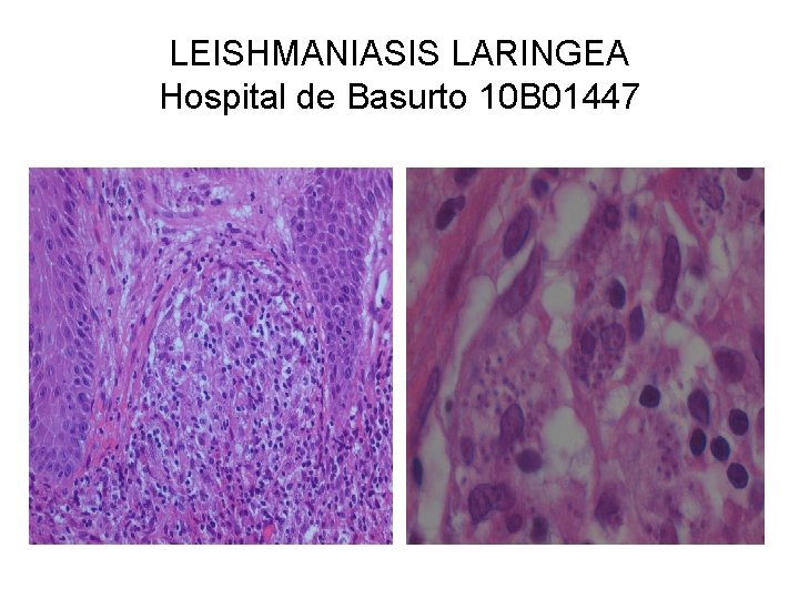 LEISHMANIASIS LARINGEA Hospital de Basurto 10 B 01447 