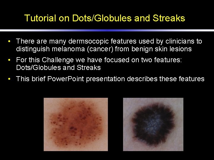 Tutorial on Dots/Globules and Streaks • There are many dermsocopic features used by clinicians