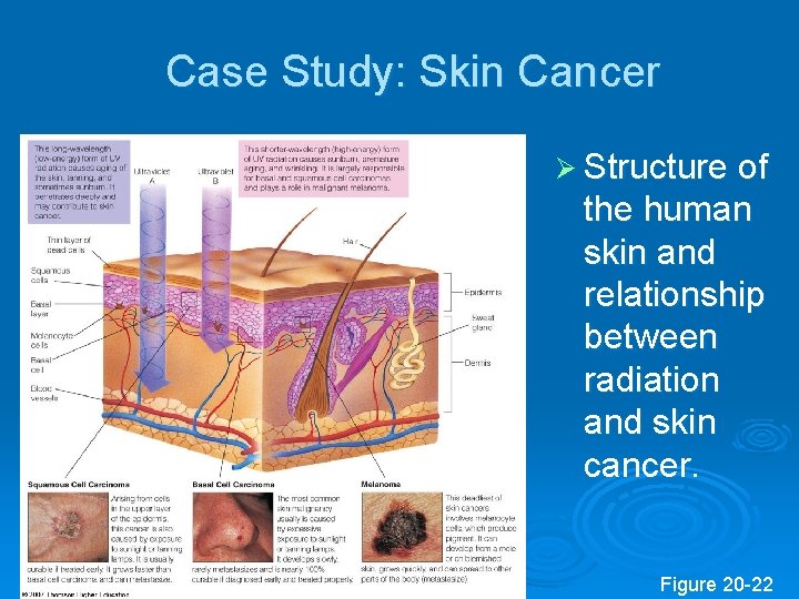 Case Study: Skin Cancer Ø Structure of the human skin and relationship between radiation Case Study: Skin Cancer Ø Structure of the human skin and relationship between radiation