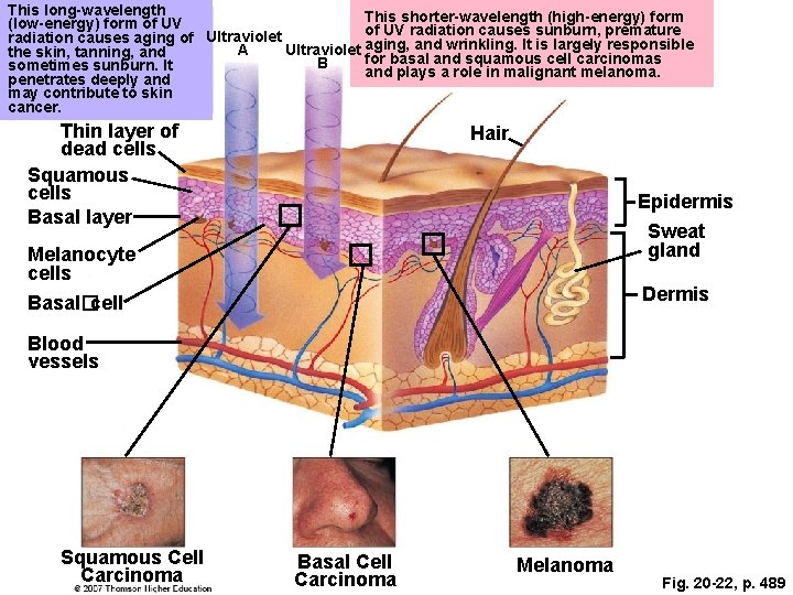 This long-wavelength This shorter-wavelength (high-energy) form (low-energy) form of UV radiation causes sunburn, premature This long-wavelength This shorter-wavelength (high-energy) form (low-energy) form of UV radiation causes sunburn, premature