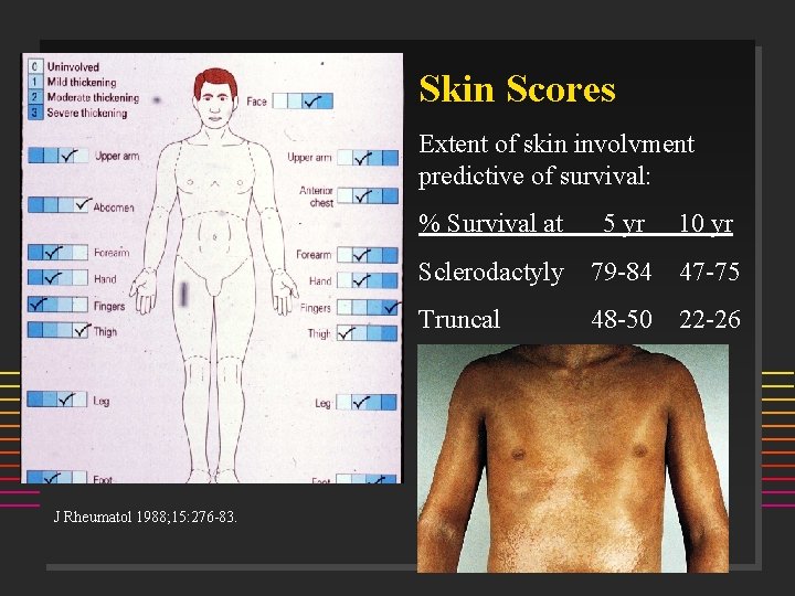 Skin Scores Extent of skin involvment predictive of survival: J Rheumatol 1988; 15: 276