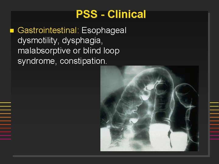 PSS - Clinical n Gastrointestinal: Esophageal dysmotility, dysphagia, malabsorptive or blind loop syndrome, constipation.