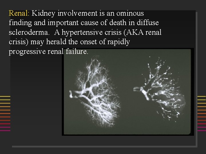 Renal: Kidney involvement is an ominous finding and important cause of death in diffuse