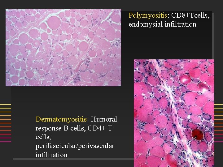 Polymyositis: CD 8+Tcells, endomysial infiltration Dermatomyositis: Humoral response B cells, CD 4+ T cells;