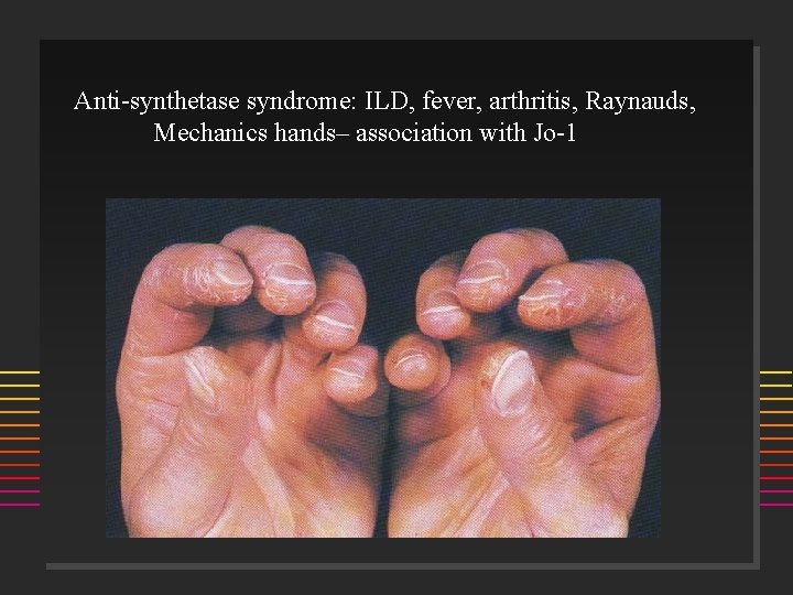 Anti-synthetase syndrome: ILD, fever, arthritis, Raynauds, Mechanics hands– association with Jo-1 