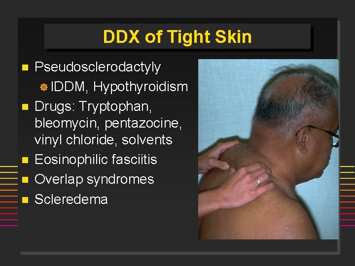 DDX of Tight Skin n n Pseudosclerodactyly ] IDDM, Hypothyroidism Drugs: Tryptophan, bleomycin, pentazocine,