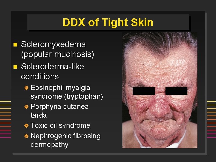 DDX of Tight Skin n n Scleromyxedema (popular mucinosis) Scleroderma-like conditions Eosinophil myalgia syndrome