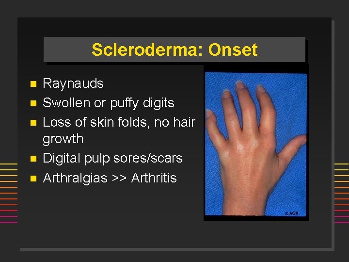 Scleroderma: Onset n n n Raynauds Swollen or puffy digits Loss of skin folds,