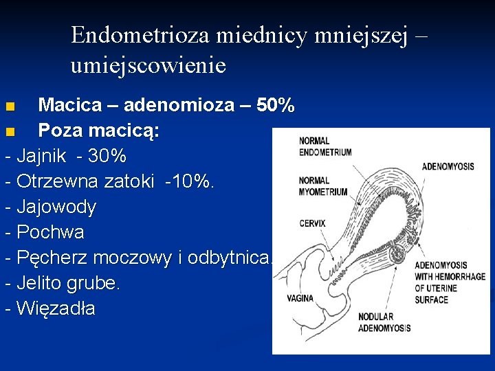 Endometrioza miednicy mniejszej – umiejscowienie Macica – adenomioza – 50% n Poza macicą: -