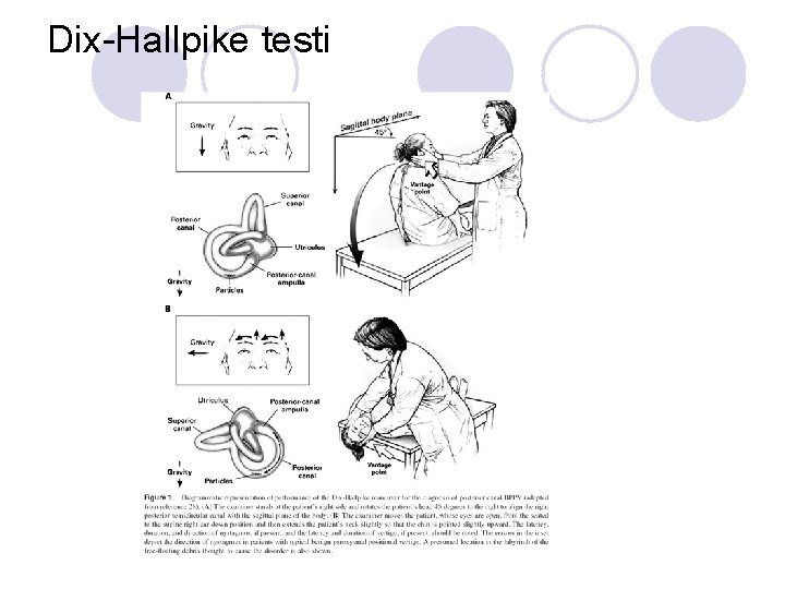 Dix-Hallpike testi 