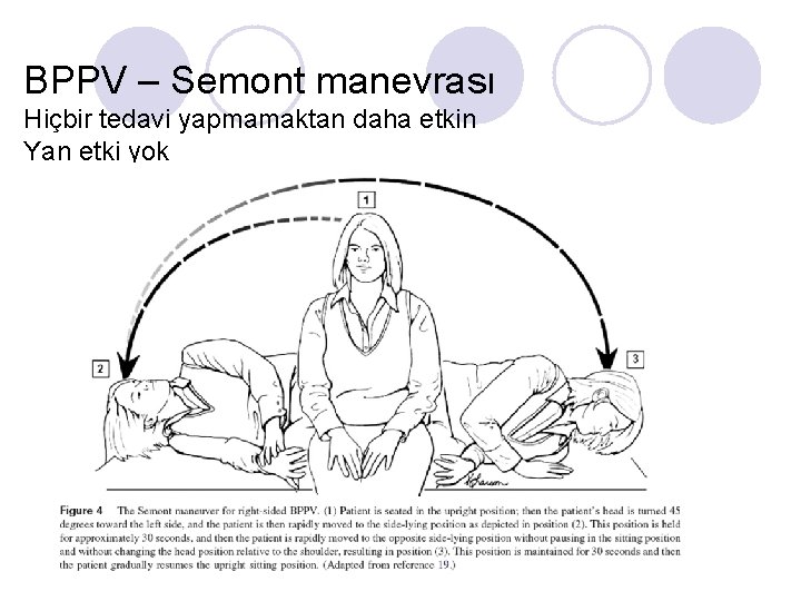 BPPV – Semont manevrası Hiçbir tedavi yapmamaktan daha etkin Yan etki yok 