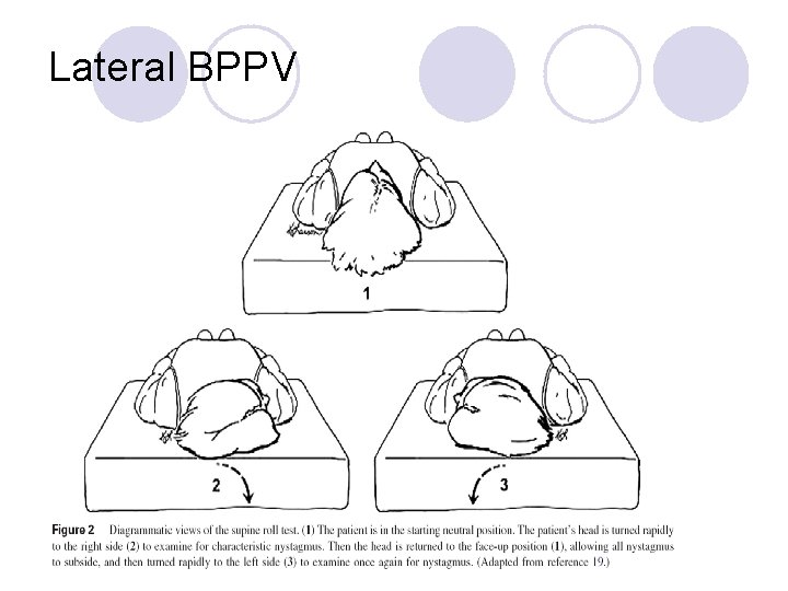 Lateral BPPV 