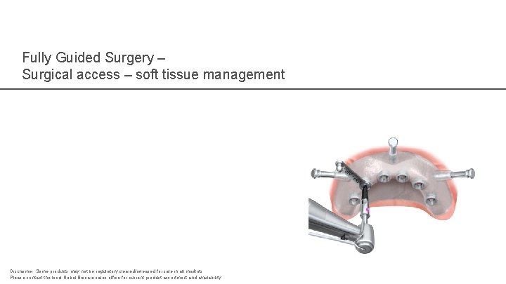 Fully Guided Surgery – Surgical access – soft tissue management Disclaimer: Some products may