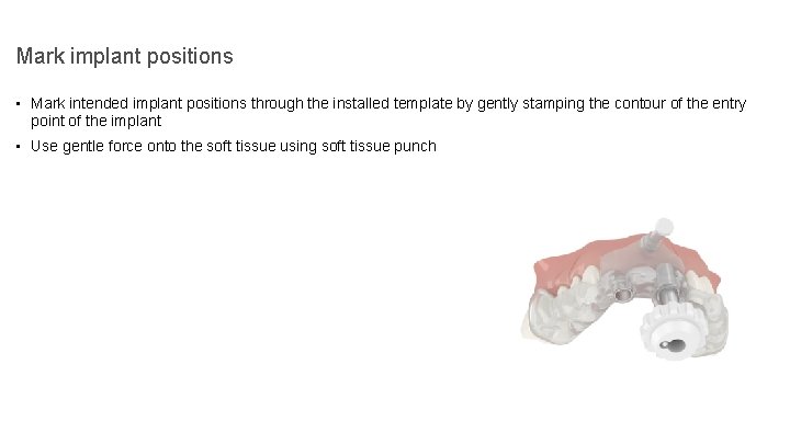 Mark implant positions • Mark intended implant positions through the installed template by gently
