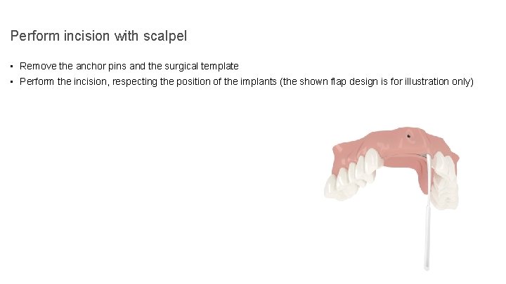Perform incision with scalpel • Remove the anchor pins and the surgical template •
