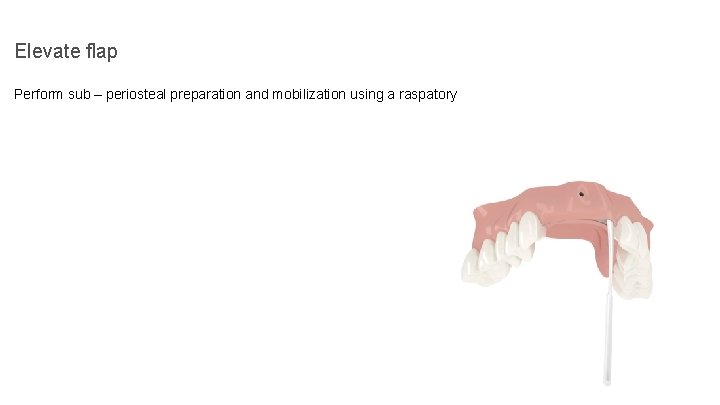 Elevate flap Perform sub – periosteal preparation and mobilization using a raspatory 