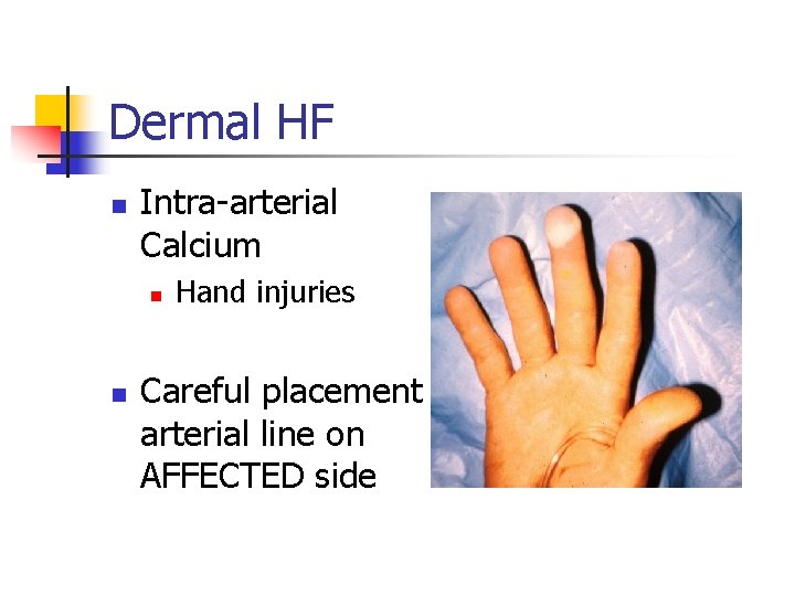 Dermal HF n Intra-arterial Calcium n n Hand injuries Careful placement arterial line on