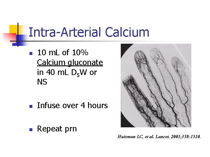 Intra-Arterial Calcium n 10 m. L of 10% Calcium gluconate in 40 m. L
