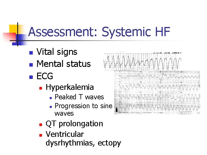 Assessment: Systemic HF n n n Vital signs Mental status ECG n Hyperkalemia n