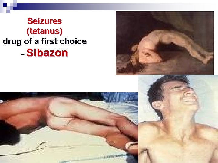 Seizures (tetanus) drug of a first choice - Sibazon 