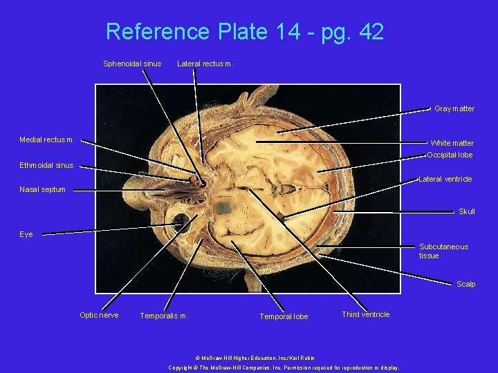 Reference Plate 14 - pg. 42 Sphenoidal sinus Lateral rectus m. Gray matter Medial