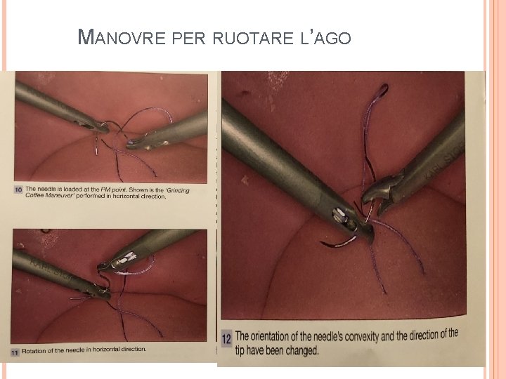 MANOVRE PER RUOTARE L’AGO 