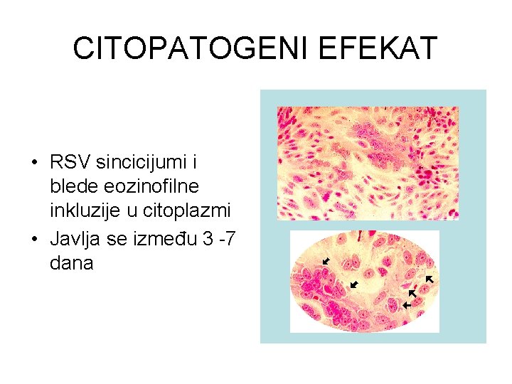 CITOPATOGENI EFEKAT • RSV sincicijumi i blede eozinofilne inkluzije u citoplazmi • Javlja se