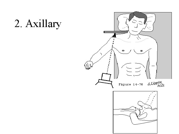2. Axillary 