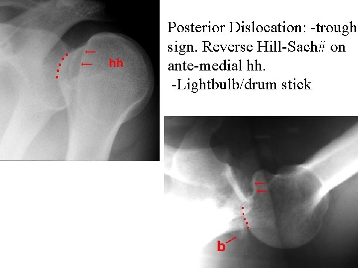 Posterior Dislocation: -trough sign. Reverse Hill-Sach# on ante-medial hh. -Lightbulb/drum stick 