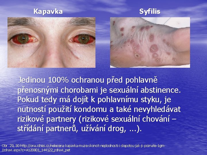 Kapavka Syfilis Jedinou 100% ochranou před pohlavně přenosnými chorobami je sexuální abstinence. Pokud tedy