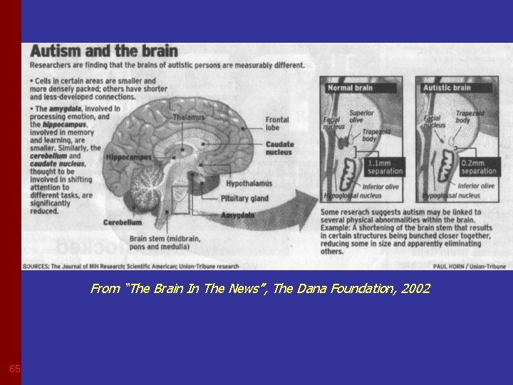 Autism and the brain……. From “The Brain In The News”, The Dana Foundation, 2002
