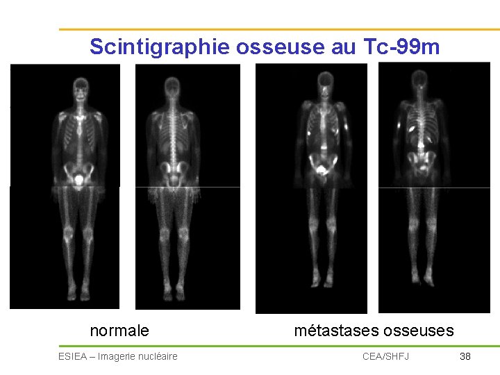 Scintigraphie osseuse au Tc-99 m normale ESIEA – Imagerie nucléaire métastases osseuses CEA/SHFJ 38