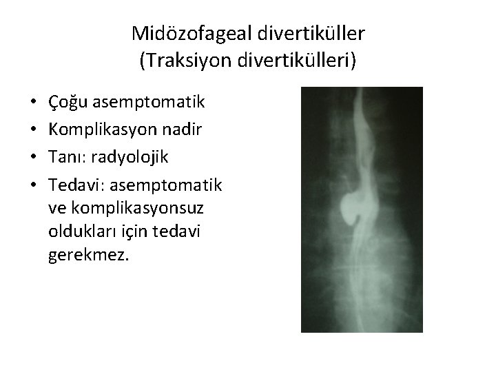 Midözofageal divertiküller (Traksiyon divertikülleri) • • Çoğu asemptomatik Komplikasyon nadir Tanı: radyolojik Tedavi: asemptomatik