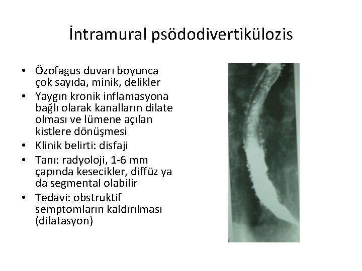 İntramural psödodivertikülozis • Özofagus duvarı boyunca çok sayıda, minik, delikler • Yaygın kronik inflamasyona