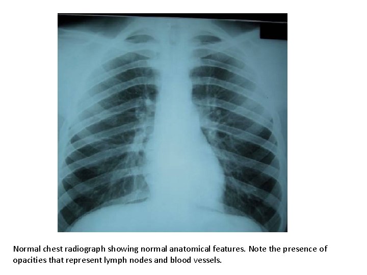 Normal chest radiograph showing normal anatomical features. Note the presence of opacities that represent
