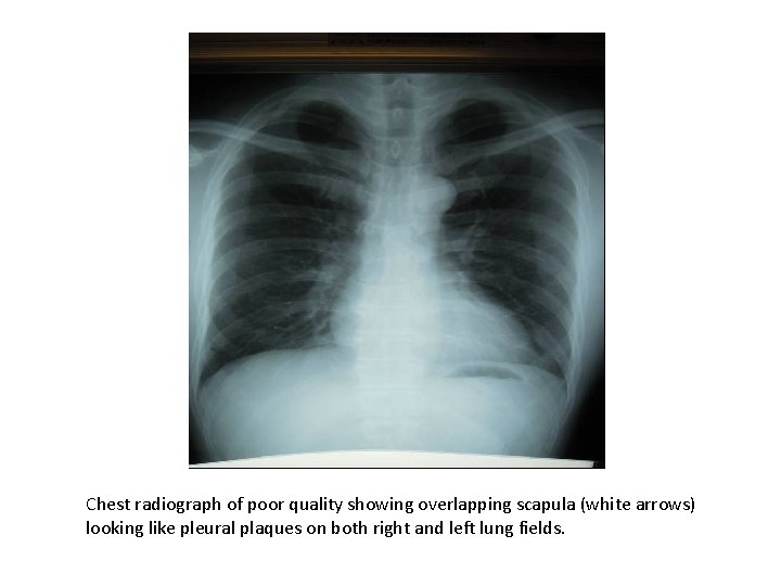 Chest radiograph of poor quality showing overlapping scapula (white arrows) looking like pleural plaques