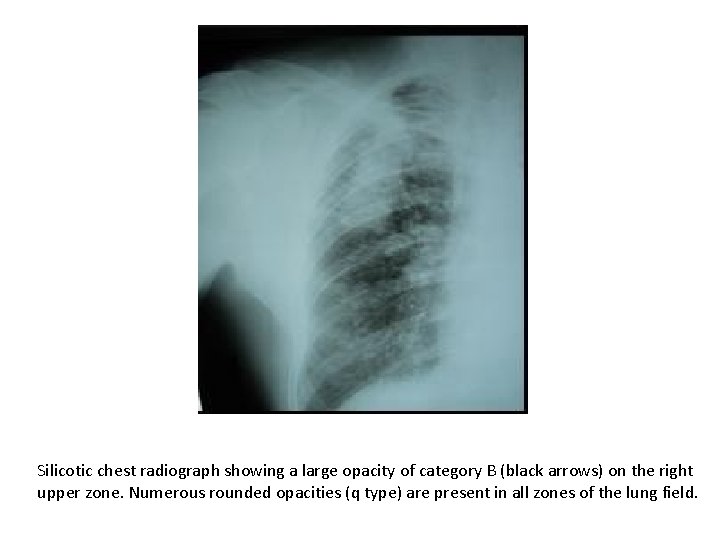 Silicotic chest radiograph showing a large opacity of category B (black arrows) on the