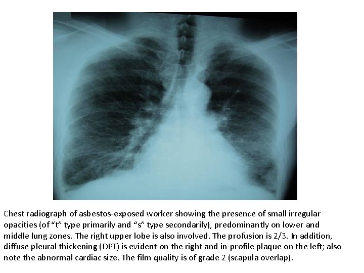 Chest radiograph of asbestos-exposed worker showing the presence of small irregular opacities (of “t”