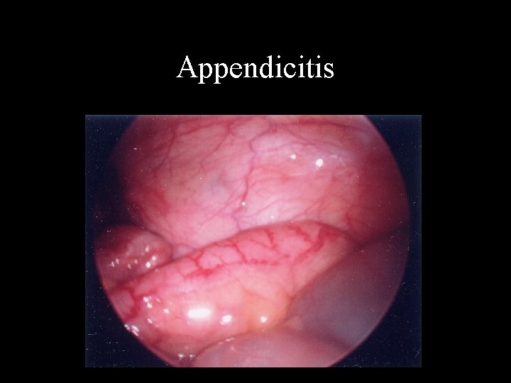 Appendicitis 