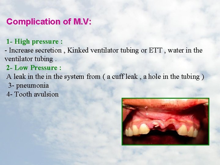 Complication of M. V: 1 - High pressure : - Increase secretion , Kinked