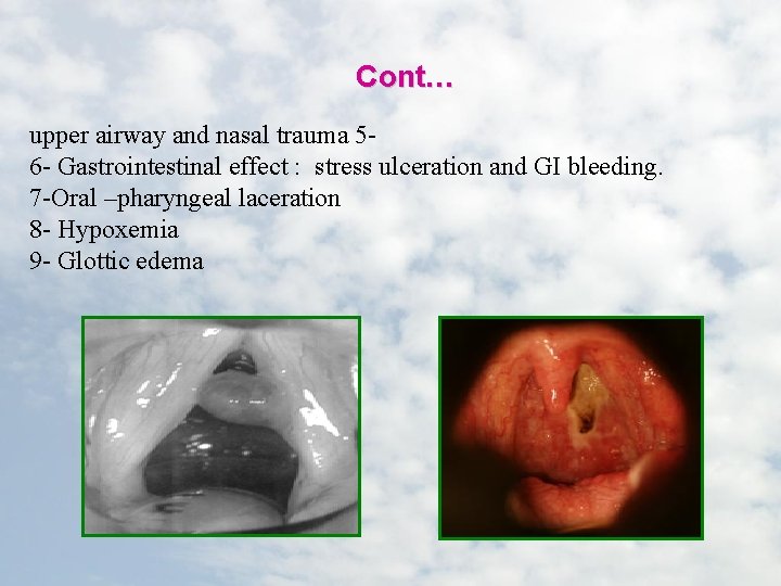 Cont… upper airway and nasal trauma 56 - Gastrointestinal effect : stress ulceration and