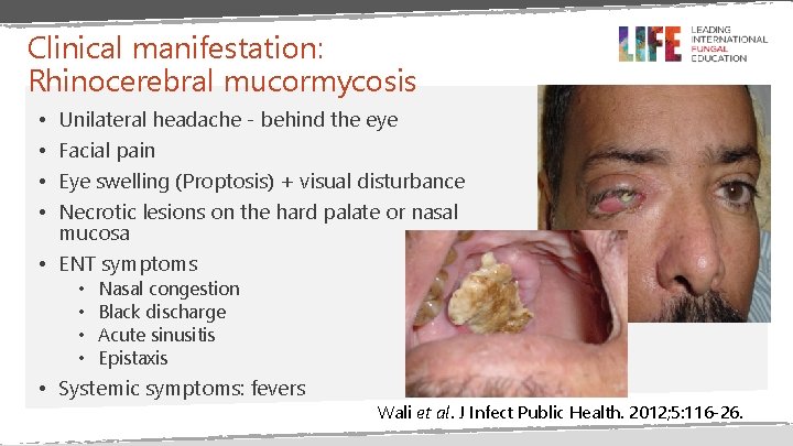 Clinical manifestation: Rhinocerebral mucormycosis Unilateral headache - behind the eye Facial pain Eye swelling