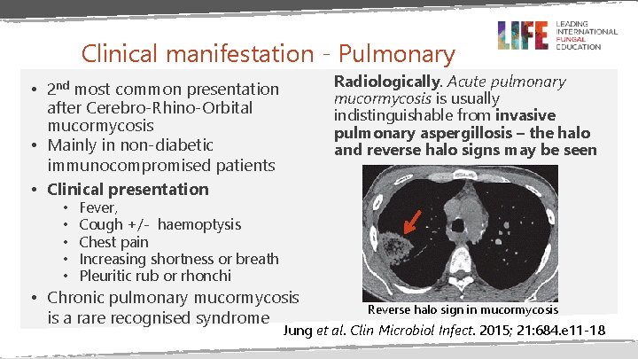 Clinical manifestation - Pulmonary Radiologically. Acute pulmonary mucormycosis is usually indistinguishable from invasive pulmonary