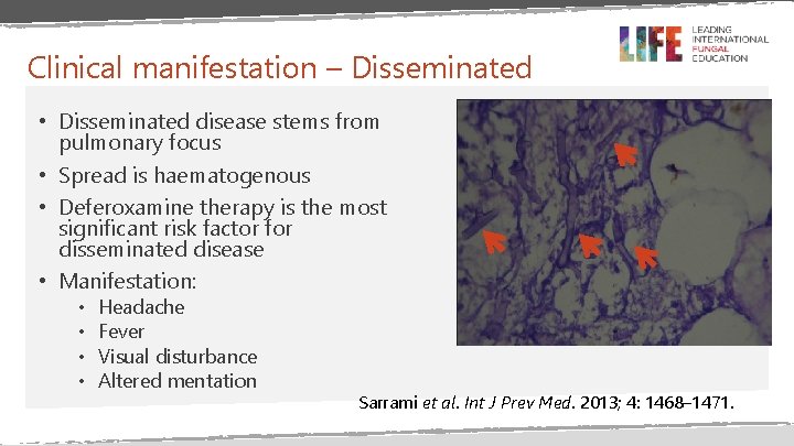 Clinical manifestation – Disseminated • Disseminated disease stems from pulmonary focus • Spread is