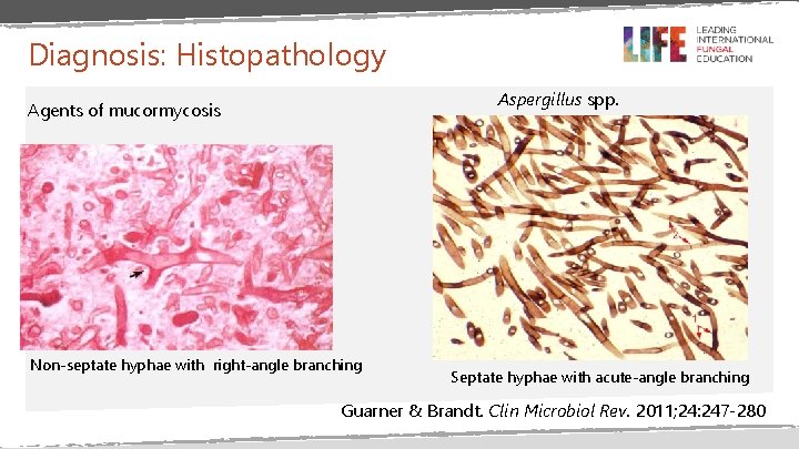 Diagnosis: Histopathology Aspergillus spp. Agents of mucormycosis Non-septate hyphae with right-angle branching Septate hyphae